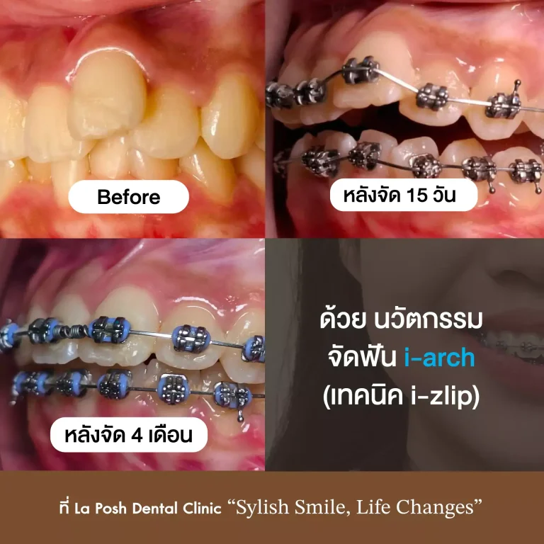 จัดฟัน i arch 6 รีวิวจัดฟัน i-Arch เทคนิค i-Zip ก่อนและหลัง