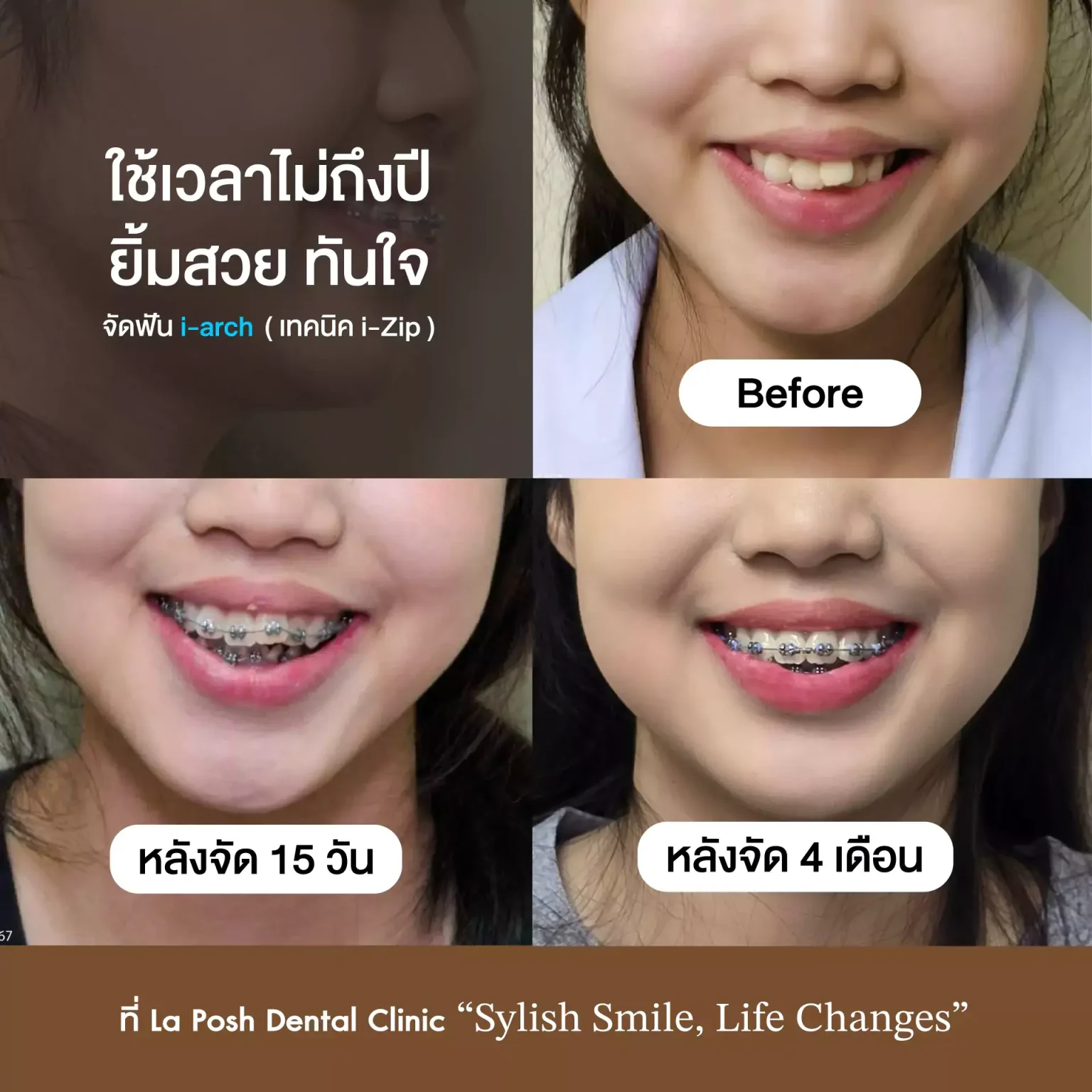 จัดฟันเหล็ก เทคนิค i-Zip 14 รีวิวจัดฟัน i-Zip หลังติด 15 วันและ 4 เดือน