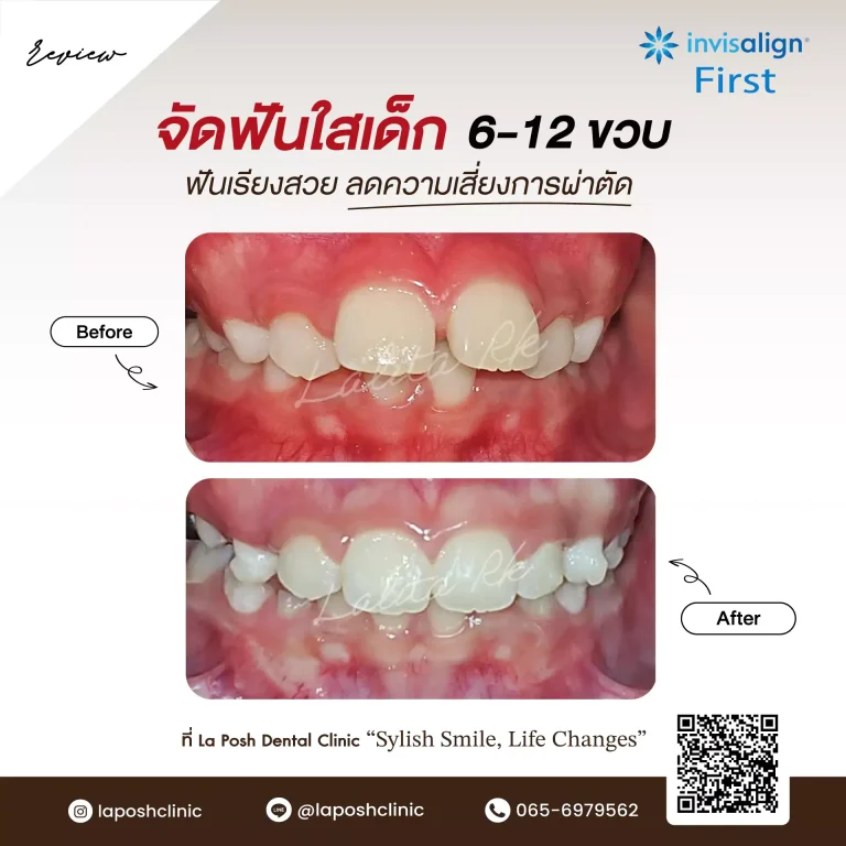 จัดฟันเด็ก 34 จัดฟันใสเด็ก 12