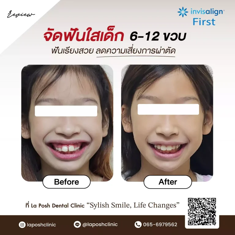 จัดฟันเด็ก 33 จัดฟันใสเด็ก 6