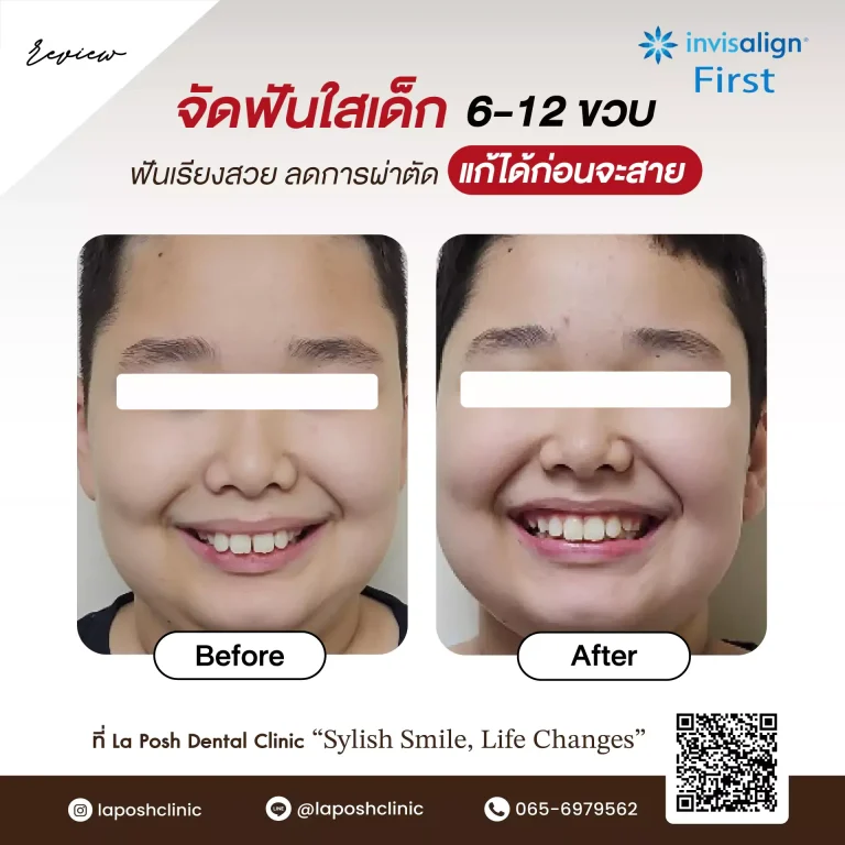 จัดฟันเด็ก 36 จัดฟันเด็ก