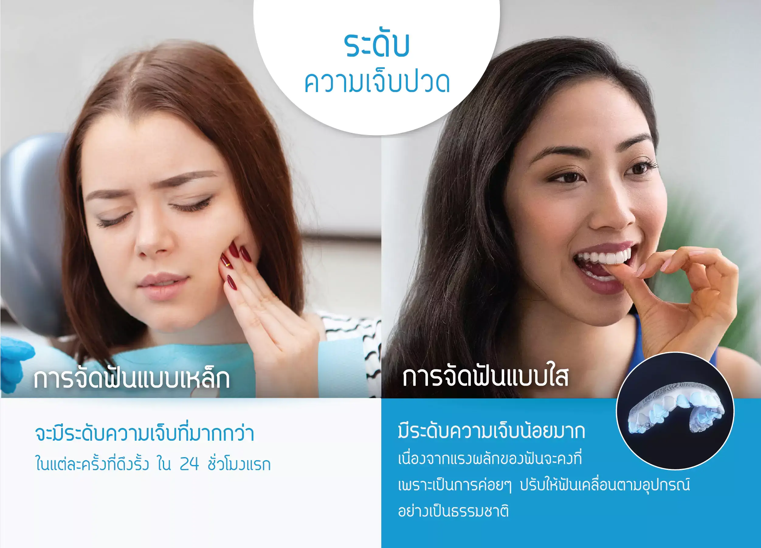 ระดับความเจ็บปวด จัดฟันใส invisalign