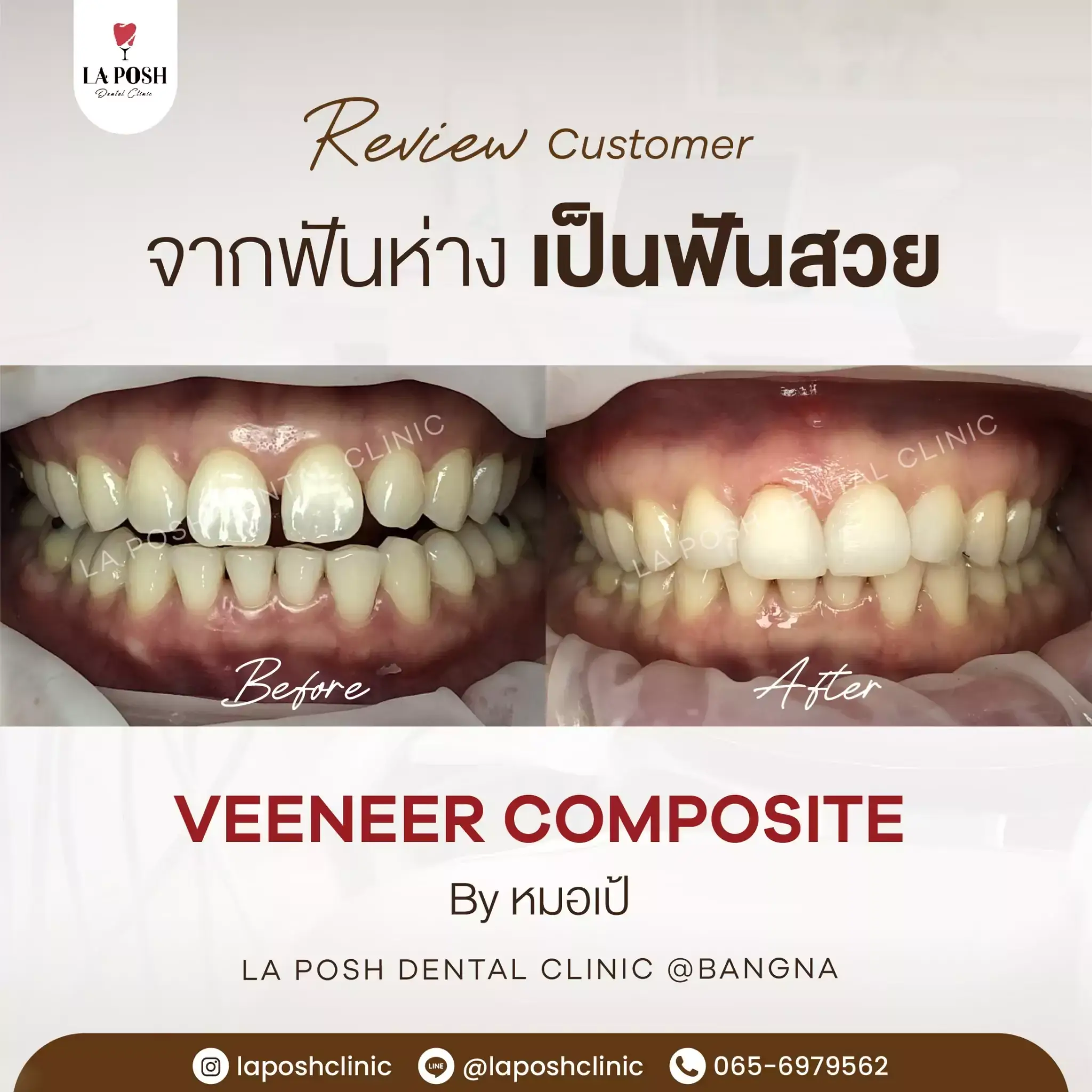 รีวิวก่อน-หลังทำวีเนียร์ แก้ปัญหาฟันห่างเป็นฟันสวย