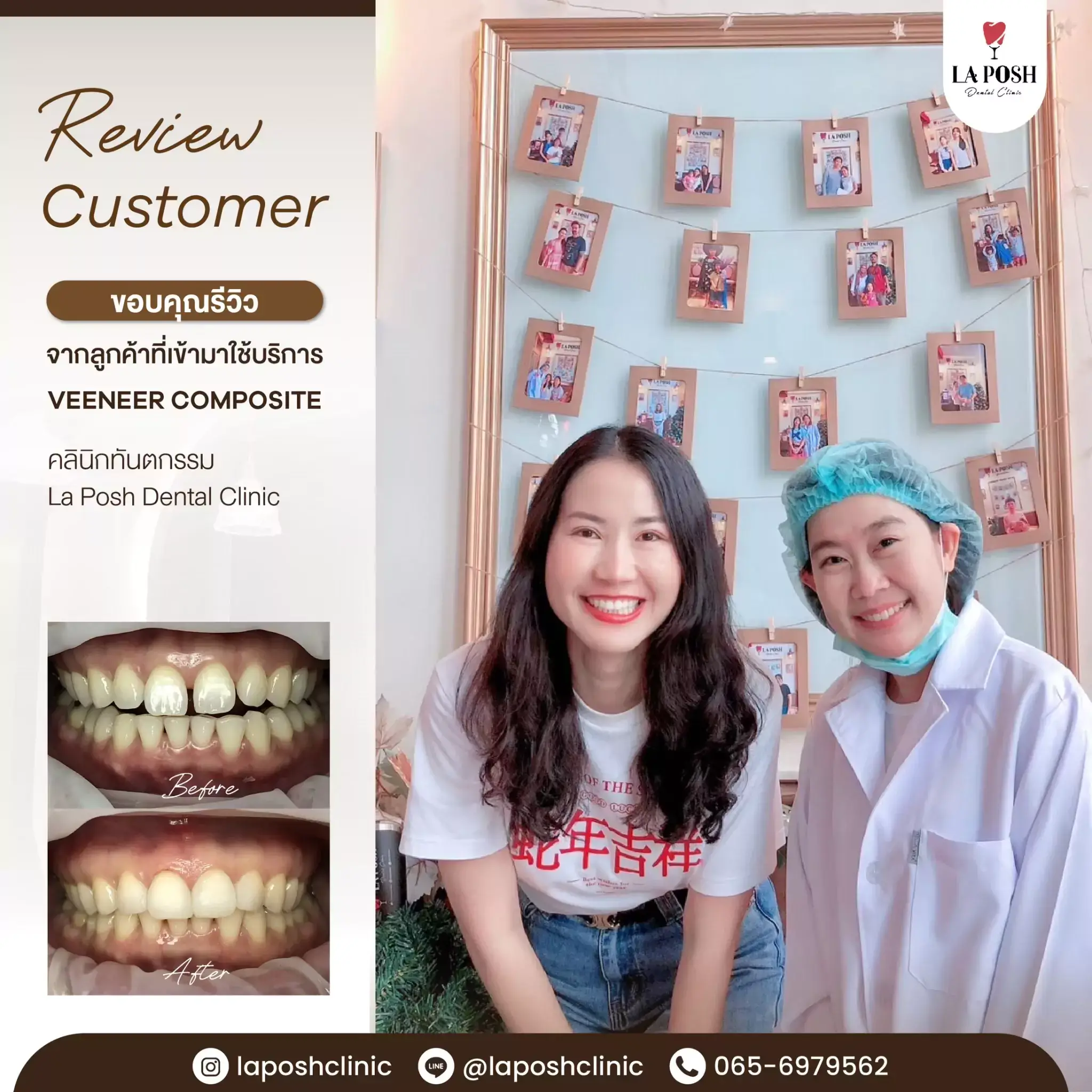 ผลงานทำวีเนียร์กับ Laposh Dental Clinic ที่ลูกค้าไว้วางใจ
