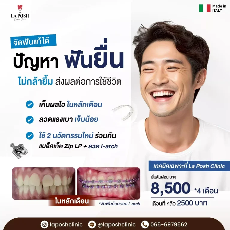 home 22 โปรโมชั่นจัดฟันแก้ฟันยื่น แบร็กเก็ต Zip LP ร่วมกับลวด i-Arch – La Posh Dental Clinic