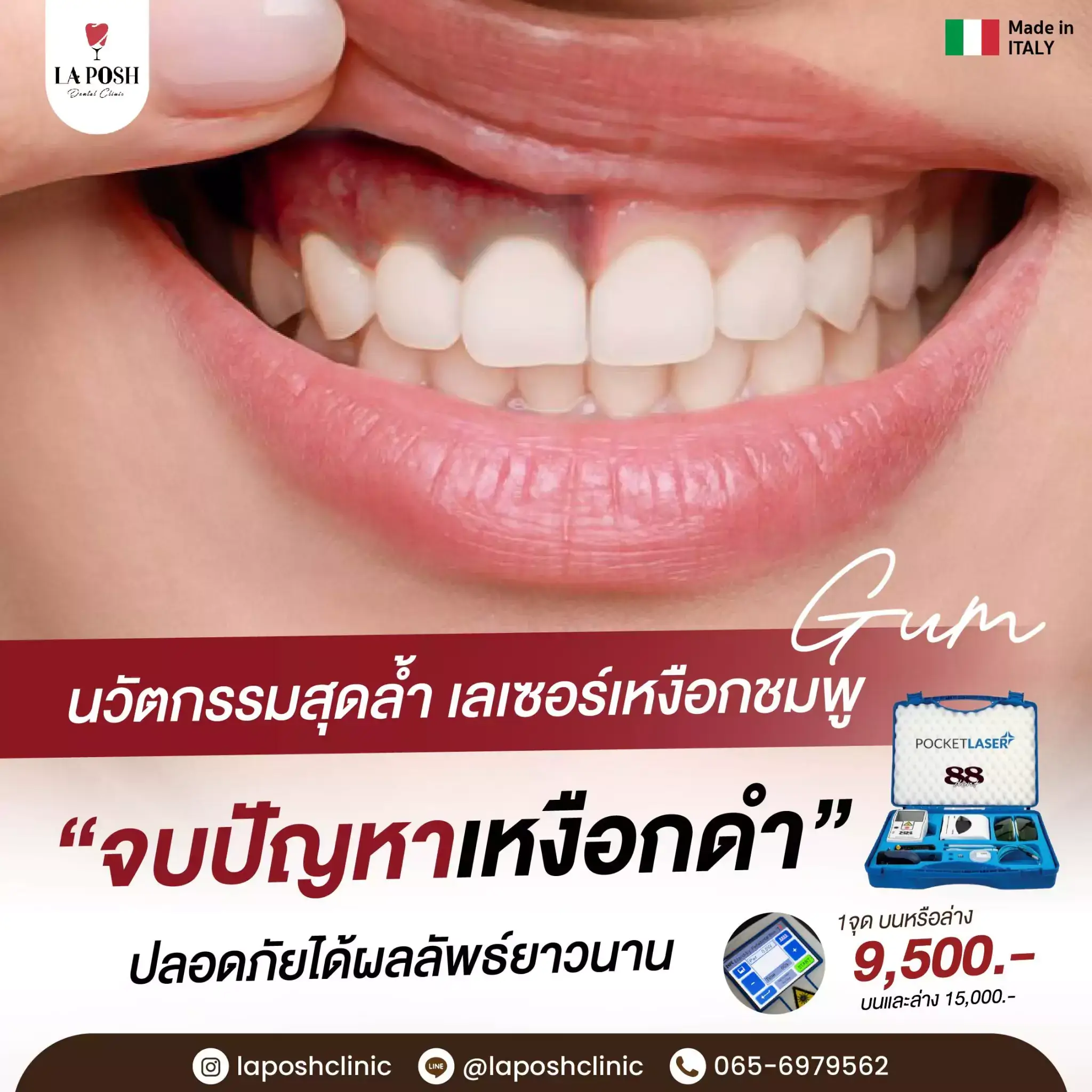 ฟอกสีฟัน เหงือกไม่ดำ