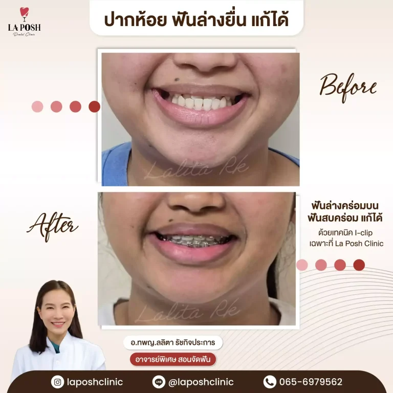 จัดฟันเด็ก 29 ปากห้อย