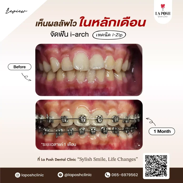 จัดฟัน i arch 9 ภาพก่อนและหลังจัดฟันเหล็ก i-Arch