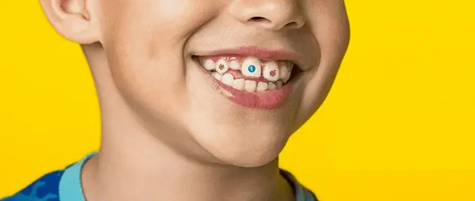 เด็กยิ้มขณะจัดฟันแบบติดแน่น บริการจัดฟันเด็กที่ La Posh Dental Clinic