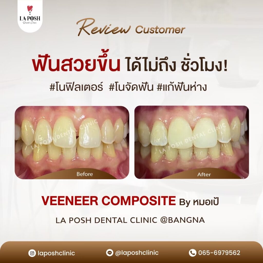 ฟันห่างควรจัดฟันหรืออุดช่องฟัน? วิธีไหนดีกว่ากัน 4 รีวิวทำวีเนียร์ La posh dental clinic