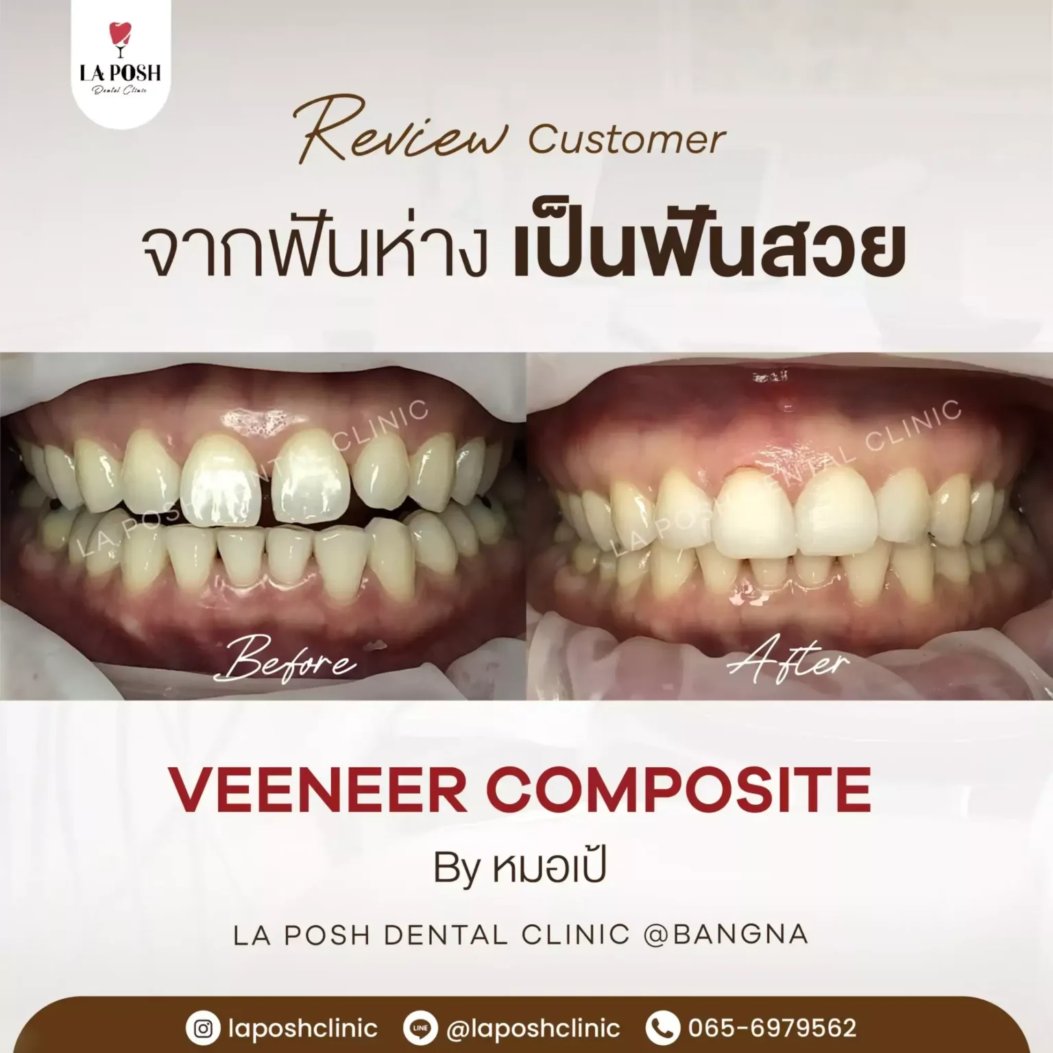 วีเนียร์ 8 รีวิวทำวีเนียร์