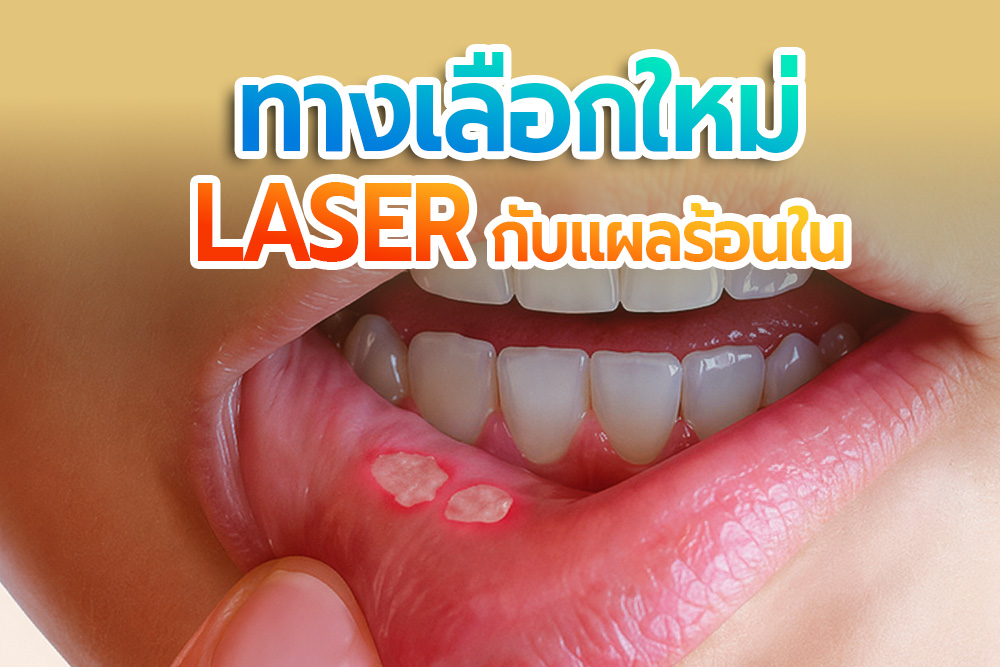 Laser กับแผลร้อนใน ทางเลือกใหม่ รักษาเร็ว หายไว ไม่ทรมาน 1 Dental laserกับแผลร้อนใน