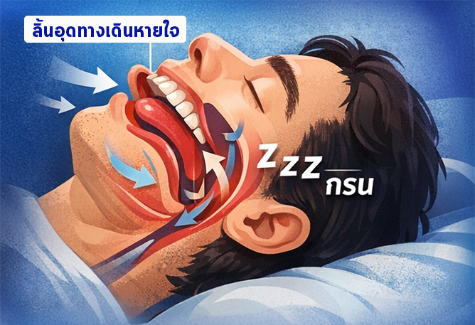 นอนกรนเพราะฟัน? เช็กความสัมพันธ์ “โครงสร้างฟัน” กับการหายใจตอนนอน 3 นอนกรนเพราะฟัน 1