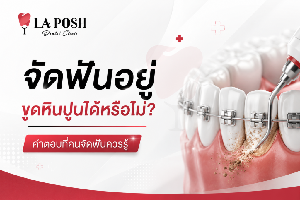 จัดฟันอยู่ขูดหินปูนได้หรือไม่? คำตอบที่คนจัดฟันควรรู้ 1 Laposh Clinic