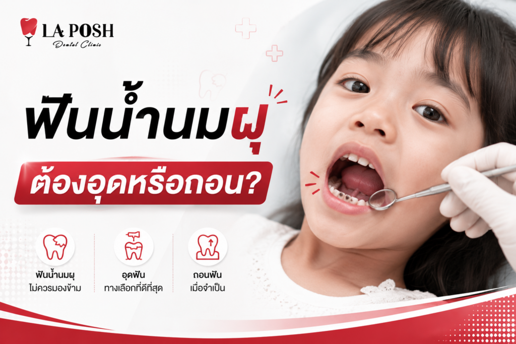 ฟันน้ำนมผุ ต้องอุดหรือถอน? คุณพ่อคุณแม่ควรรู้อะไรก่อนตัดสินใจ 1 Dental laposh ฟันน้ำนมผุต้องอุดหรือถอน
