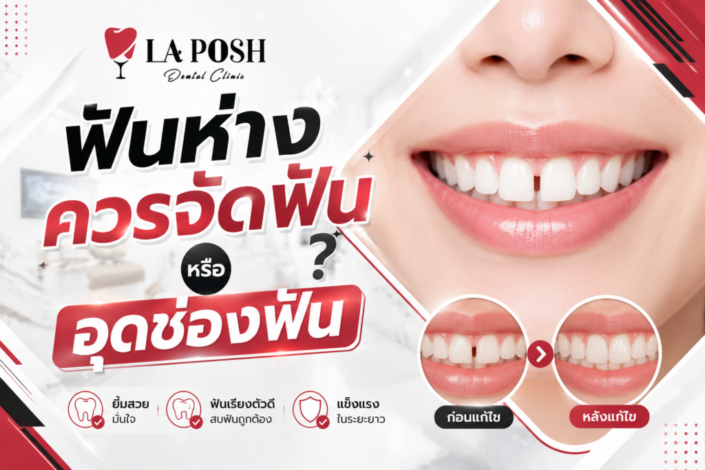 ฟันห่างควรจัดฟันหรืออุดช่องฟัน? วิธีไหนดีกว่ากัน 1 Dental laposh ฟันห่างควรจัดฟันหรืออุดช่องฟัน