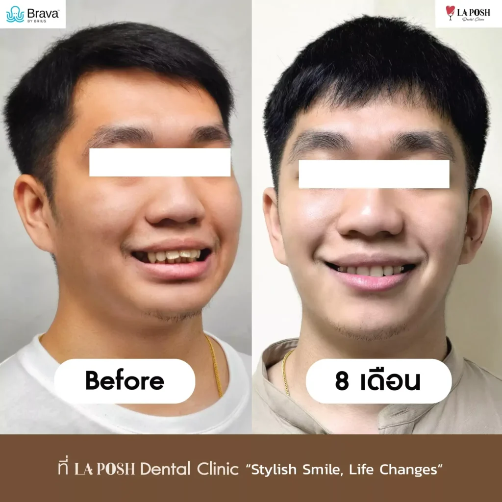 ลืมใส่รีเทนเนอร์ ฟันจะล้มไหม? ลืมกี่วันถึงเริ่มเสี่ยง และควรทำอย่างไร 2 จัดฟัน Brava laposhclinic 2