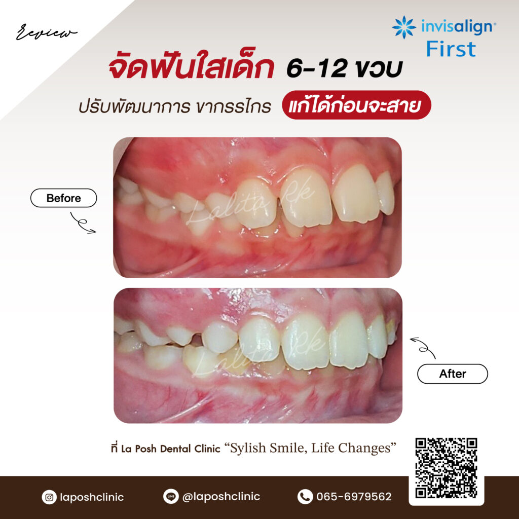 จัดฟันเด็ก ย่านบางนา ที่ La Posh Dental Clinic รอยยิ้มที่ดี…เริ่มต้นได้ตั้งแต่วัยเด็ก 8 จัดฟันใสเด็ก