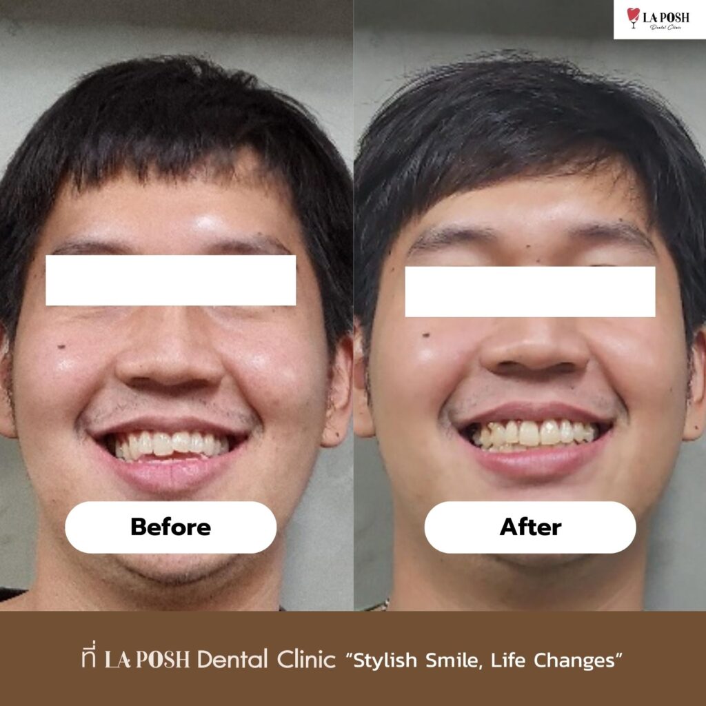 จัดฟันใส ย่านบางนา ที่ La Posh Dental Clinic เพราะรอยยิ้มที่มั่นใจ…เริ่มต้นได้แบบไม่ต้องติดเหล็ก 2 รีวิว จัดฟันใส Laposhclinic 1