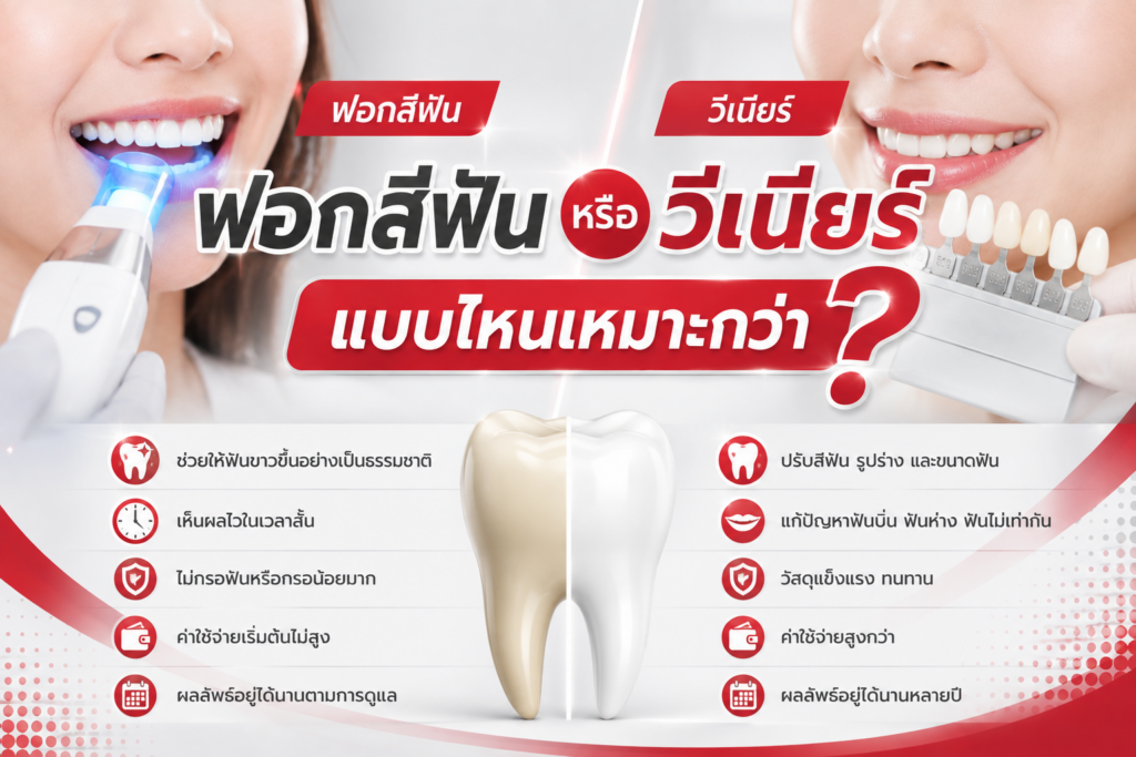 ฟอกสีฟันหรือวีเนียร์ แบบไหนเหมาะกว่า? เปรียบเทียบก่อนตัดสินใจเปลี่ยนรอยยิ้ม 1 ฟอกสีฟันหรือวีเนียร์