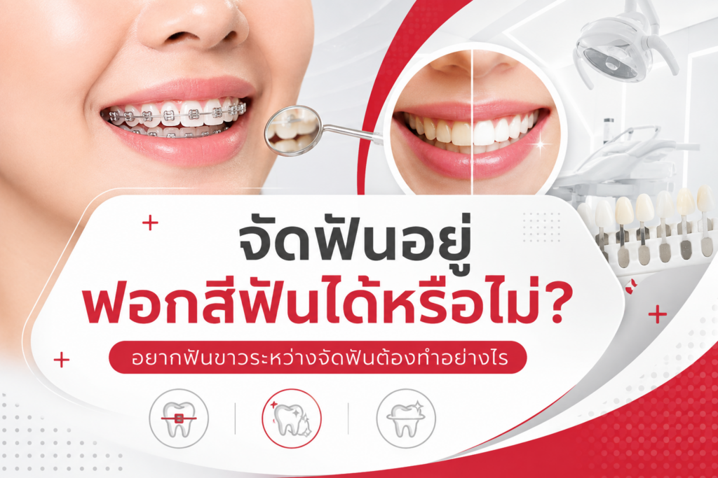 จัดฟันอยู่ ฟอกสีฟันได้หรือไม่? อยากฟันขาวระหว่างจัดฟันต้องทำอย่างไร 1 จัดฟันอยู่ฟอกสีฟันได้หรือไม่